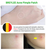 0.1mm Acne Pimple Patch Stickers Waterproof Acne Treatment Pimple Remover Tool Blemish Spot Facial Mask Skin Care 22 patches/bag