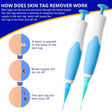 2 In1 Painless Auto Skin Tag Mole Wart Removal Kit Cleaning Tools Face Skin Care Body Wart Dot Treatments Remover Beauty Health