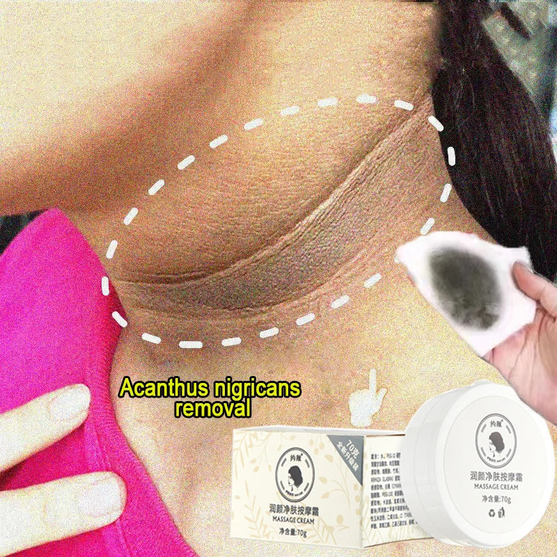 Anti Acanthosis Nigricans Whitening Cream Remove Melanin Armpit Elbow Private Care Products Body Butt Black Sitting Print Remove