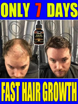 Best-selling Hair Growth Products, Anti-Hair Loss Hair Growth Serum for Men and Women, Fast Hair Growth Oil, 100% Natural