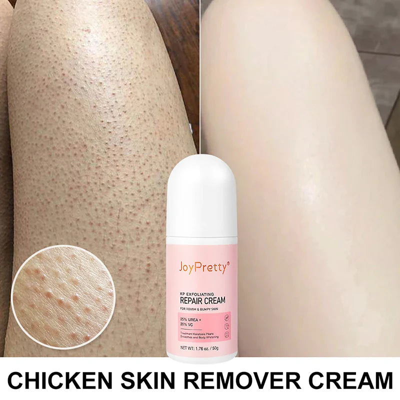 Body Cream Chicken Skin Removal Treatment Keratosis Pilaris Lotion Bumpy Rough Pore Spots Care Moisturizer Whitening Creams 60g