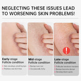 Body Cream Chicken Skin Removal Treatment Keratosis Pilaris Lotion Bumpy Rough Pore Spots Care Moisturizer Whitening Creams 60g