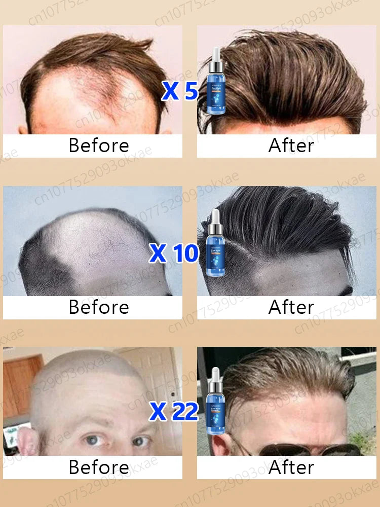 Fast Hair Growth Essence Oil Products Effective Baldness Repair Treatment Anti Hereditary Seborrheic Alopecia Loss For Men Women