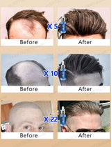 Fast Hair Growth Essence Oil Products Effective Baldness Repair Treatment Anti Hereditary Seborrheic Alopecia Loss For Men Women