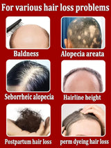 Hair growth oil,effective baldness repair, hereditary hair loss, postpartum hair loss