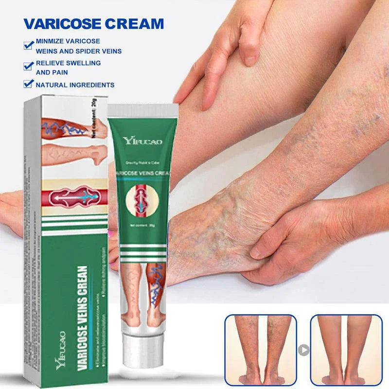 Varicose Vein Treatments Cream Effective Relieve Legs Dilated Vasculitis Phlebitis Natural Formula Ointment For Varicose Veins