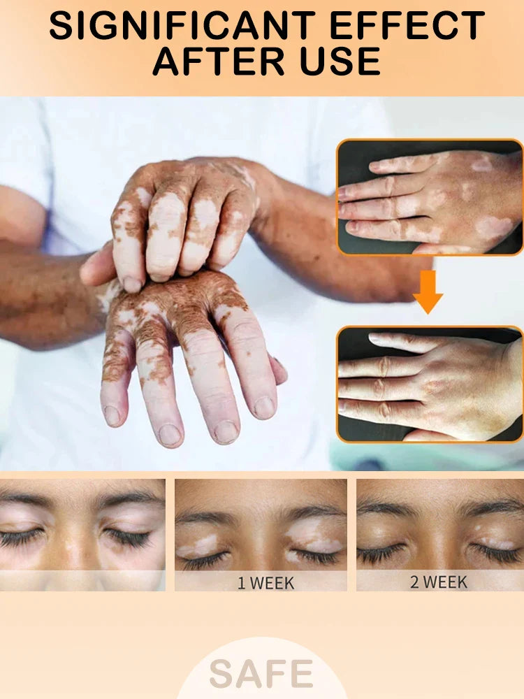 Herbal Extract Vitiligo Ointment Remove Ringworm White Spot Removal Skin Vitiligo Eliminate Vitiligo