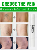 Powerful Laser Therapy for Moderate Varicose Veins, Relieve Pain and Improve Circulation for Both Men and Women