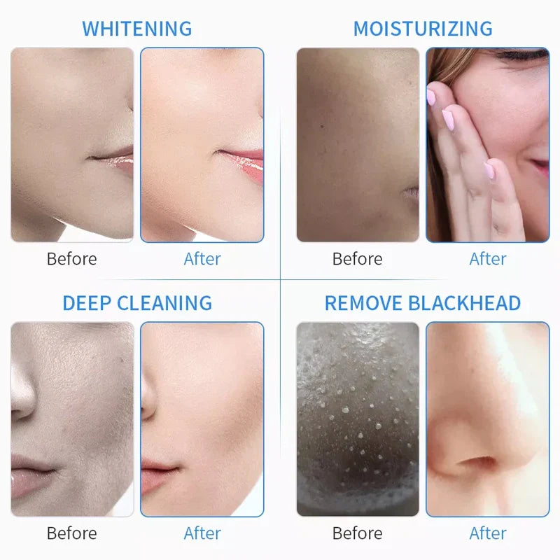 15/5/3PCSPcs 30ml Aqua Peeling Solution AS1 SA2 AO3 Strong Cleansing Skin Care for Hydra Dermabrasion Beauty Machine Facial