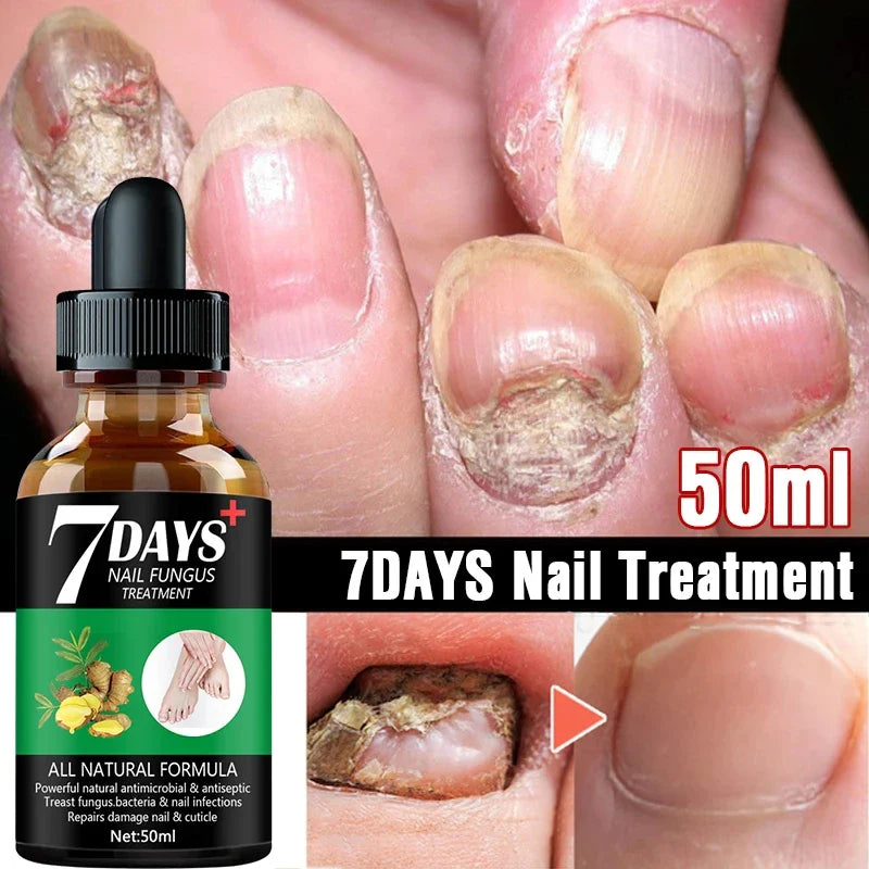 7DAYS Repair Nail Fungus Treatments Essence Foot Care Serum Toe Nails Fungal Removal Gel Anti-Infection Onychomycosis Care Tool