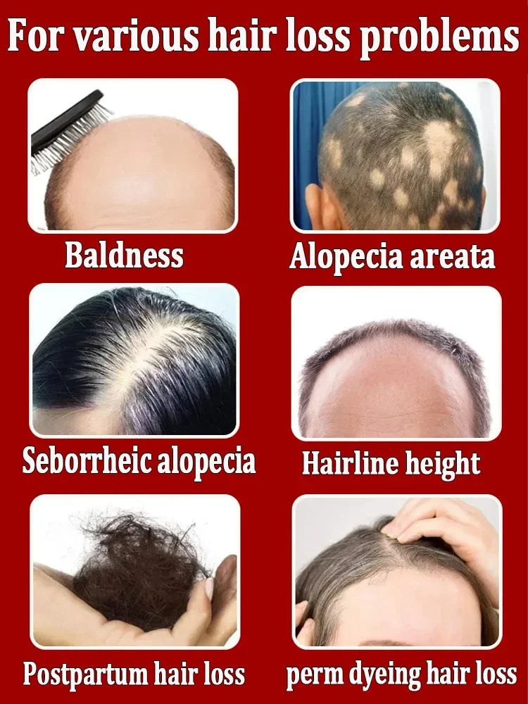 Hair growth essence can quickly grow hair and effectively repair baldness, alopecia areata, hereditary hair loss, postpartum hai