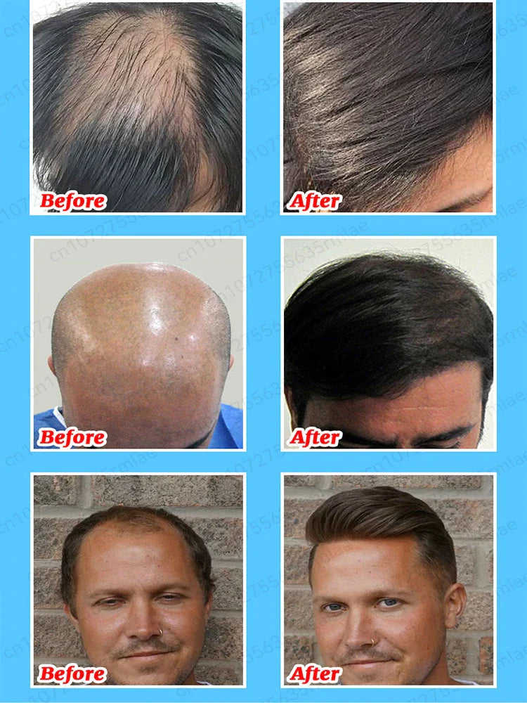 Hair growth essence can quickly grow hair and effectively repair baldness, alopecia areata, hereditary hair loss, postpartum hai