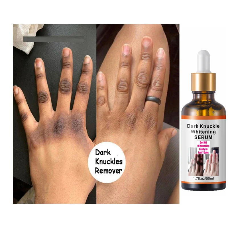 Get Rid Of Dark Knuckles In 7 Days Serum Whitening Removing Dark knuckles Serum Hand knuckle Eraser Serum for Elbow and Knee