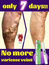 Powerful Laser Therapy for Moderate Varicose Veins, Relieve Pain and Improve Circulation for Both Men and Women