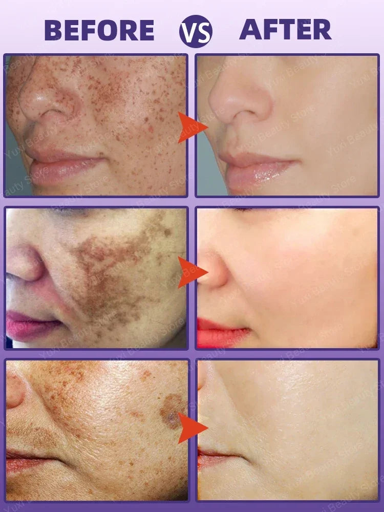 Whitening Freckle Cream Dark Spot Remover Deep Melasma  Age Sun Spots