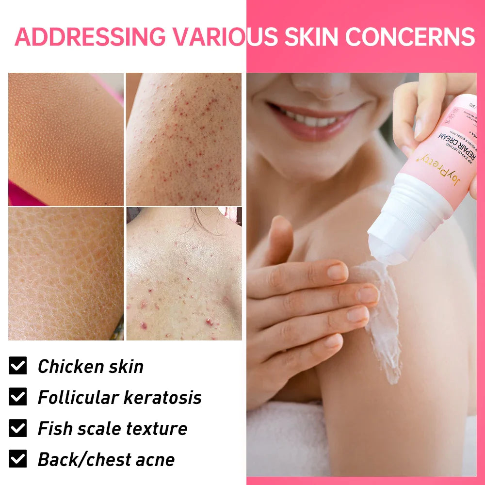 JoyPretty Body Cream Chicken Skin Removal Treatment Pore Keratosis Pilaris Lotion Urea Skin Moisturizing Whitening Creams Care