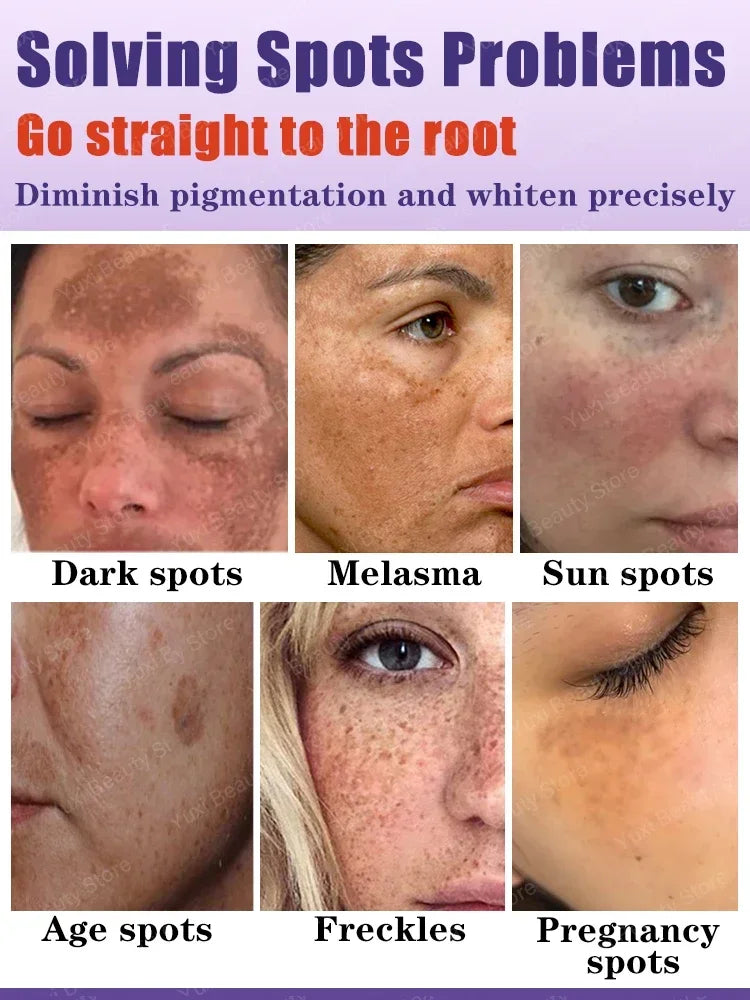 Whitening Freckle Cream Dark Spot Remover Deep Melasma  Age Sun Spots