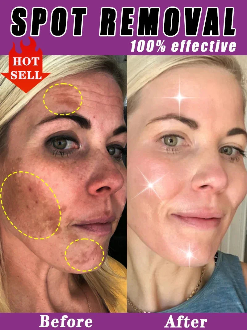 Whitening Freckle Cream Dark Spot Remover Deep Melasma  Age Sun Spots