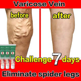 Varicose Vein Treatments Cream Effective Relieve Legs Dilated Vasculitis Phlebitis Natural Formula Ointment For Varicose Veins